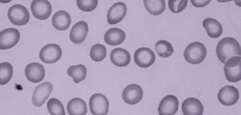 Iron deficiency anemia shown in red blood cells at 400X. Due to lesser amounts of haemoglobin, the cells have an abnormally large central pallor 